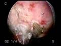 Obesity, menorrhagia and severe Anemia