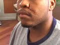 PLASTIC SURGERY: GEOMETRIC BROKEN LINE SCAR REVISION DALLAS  Plastic and Cosmetic Surgery Scars