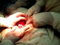ovarian mass after cs hysterectomy2