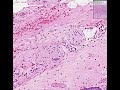 Histopathology Prostate --Adenocarcinoma (Gleason grade 3) Histopathology Prostate --Adenocarcinoma (Gleason grade 3)