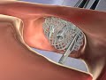 Spine Surgery Animation - Neurologic & Orthopedic Hospital