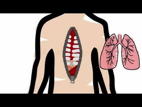 how to transplant lungs