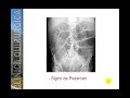 ABDOMEN AGUDO PERFORATIVO 3