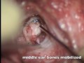 Combined Atresia-Microtia v2