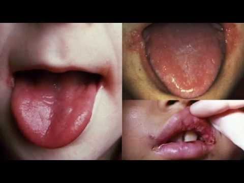 how to get rid of a yeast infection in 24 hrs