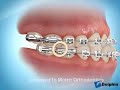 Underbite Correction Using Rubber Bands