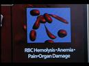 Sickle Cell patients in Worse Pain Than Previously Thought