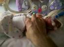 Anthony with the bilirubin light off Bilirubin