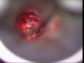 stapedotomy عملية تصلب عظم الركاب otosclerosis