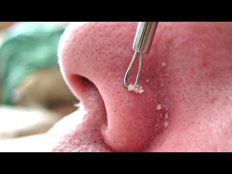 how to do acne extractions at home