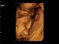 Dzaky Mom 6 Month Pregnant   4 Dimension UltraSonoGraphy 5 Ultrasonography