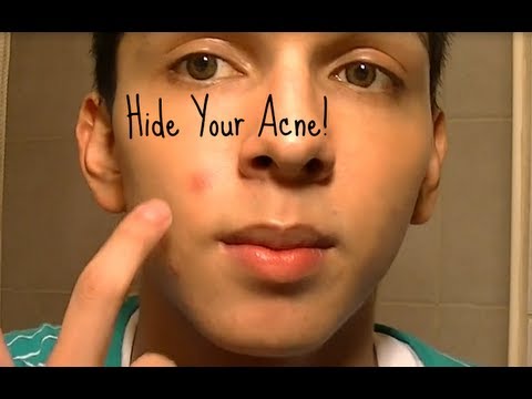 how to hide acne