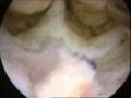 Hysteroscopic Myomectomy