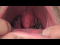 Tonsillectomy 4 Hours After Surgery Tonsillectomy 4 Hours After Surgery