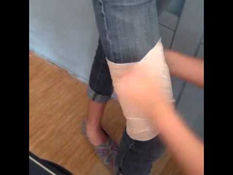 how to treat quadricep contusion