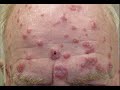 cardiovascular and lymphatic infections part 1 Lymphatic Diseases