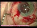 Suturing an intraocular lens with two-point fixation