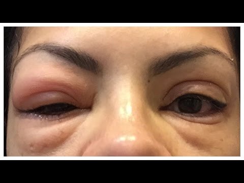 how to dissolve eyelash extension glue