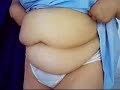 Tummy tuck Tummy tuck