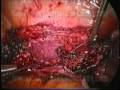 Dr. Carlos Rotman - Laparoscopic Trachelectomy