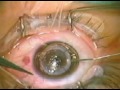Keratoplastia penetrante