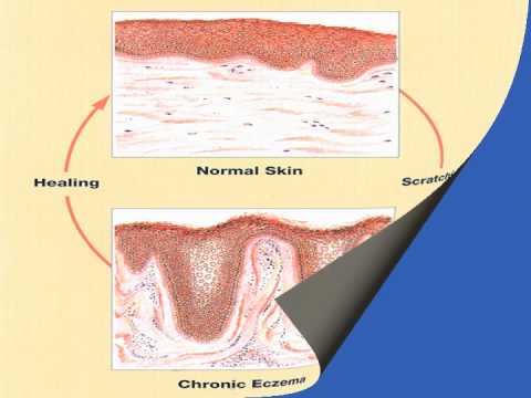 A Presentation Detailing Behavioural Modification Treatments for Atopic Dermatitis
