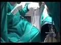 AVOID HYSTERECTOMY