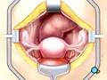 PreOp-Patient-Educat