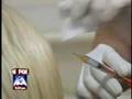 ArteFill - Amazing new wrinkle filler