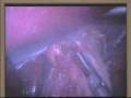 videos de Laparoscopic Fundoplocation