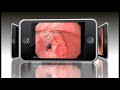 Gastric Cancer Endoscopic Animation