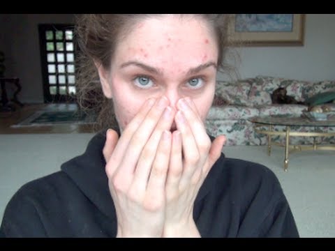 Acne Update - Flake Monster!