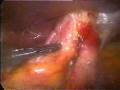videos de dr. Omar Camacho funduplicatura de nissen 1era parte