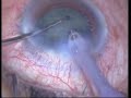 Phaco-Ozil-Bad cornea Phaco-Ozil-Bad cornea