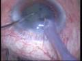 Phaco-Ozil-Bad cornea