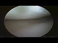 Inside My Knee