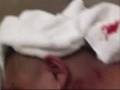 videos de cyst removal 1.wmv