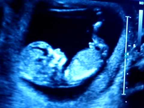 Clear 13 week ultrasound of our baby Mason.
