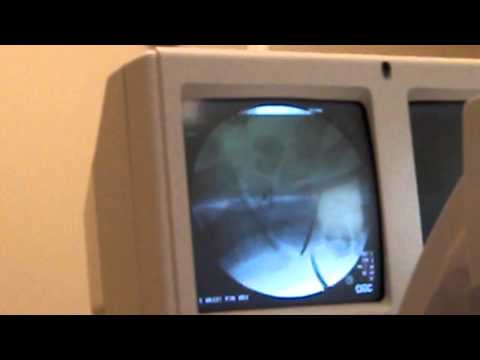 how to remove k wires