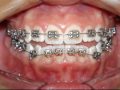 Ortodontia corretiva – Técnica Straight Wire