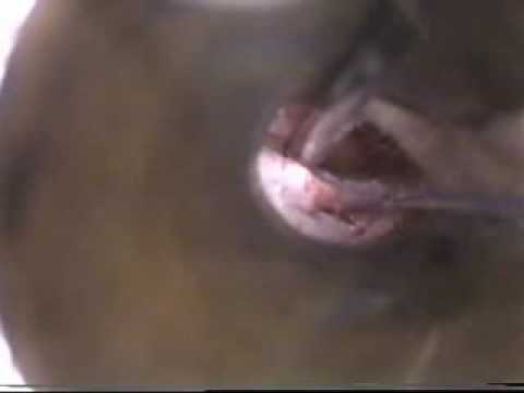Canal Wall Incisons in ear surgeries