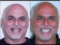 CALL TODAY FOR A TELEPHONE CONSULTATION AND QUOTE We speak English and assist with travel. Credit cards accepted dentist-algodones.com SAVE 75-90% OVER US PRICES Bridges are not the standard of care anymore for most people who lose teeth; Los Algodones dentist say implants are the treatment of choice. In an overwhelming majority of cases, Los Algodones dentist use implants to replace lost teeth are by far the best long-term solution for maintaining a healthy mouth. Also, because they rarely need to be replaced, in the long run they are more economical than a bridge says the Los Algodones dentist. According to Los Algodones dentists bridge is not a permanent solution and makes it too hard for most people to keep their gums and underlying bone healthy. Now we use Los Algodones dentist implants and individual crowns where needed.