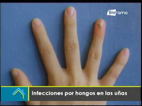 Infecciones por hongos en las uñas