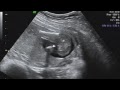 Reese's Little Sister To-Be
