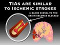 Symptoms of Stroke (Stroke #3)