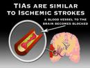 Symptoms of Stroke (Stroke #3)