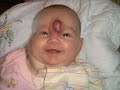 The birth and death of a Hemangioma The birth and death of a Hemangioma