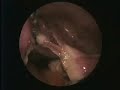 laparoscopic hysterectomy