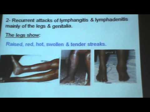 how to treat wuchereria bancrofti