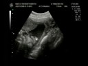 Ultrasound Rakelly 29 semanas Parte 1